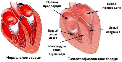 Миокарда левого желудочка 