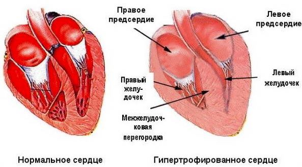 Схема гипертрофированного сердца