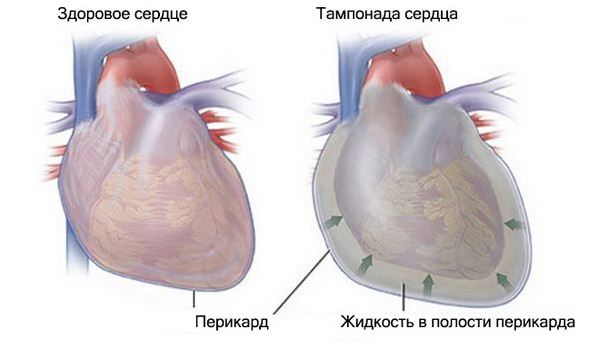 Опасность и последствия жидкости в сердце