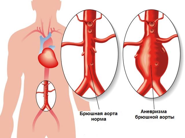 Проблема атеросклероза аорты сердца